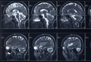 Most Common Brain Injuries Caused by South Carolina Auto Accidents