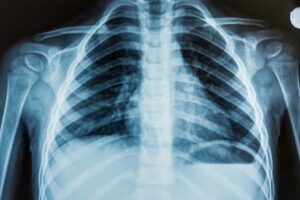 Workers’ Compensation and Personal Injury Claims Due to Occupational Lung Diseases