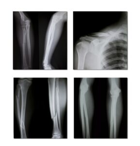 Proving Injuries In an Auto Accident Case